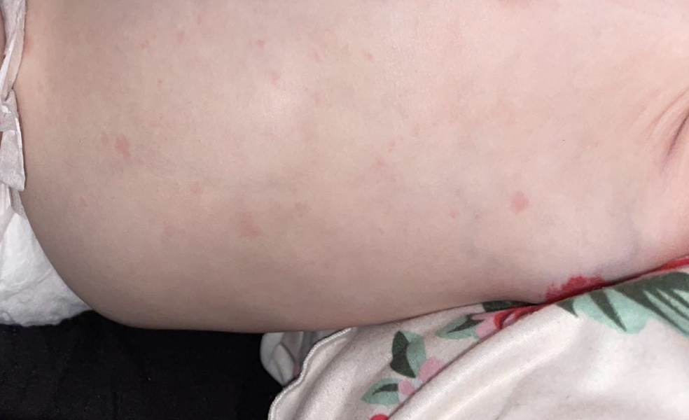 Red blotches 7 month old