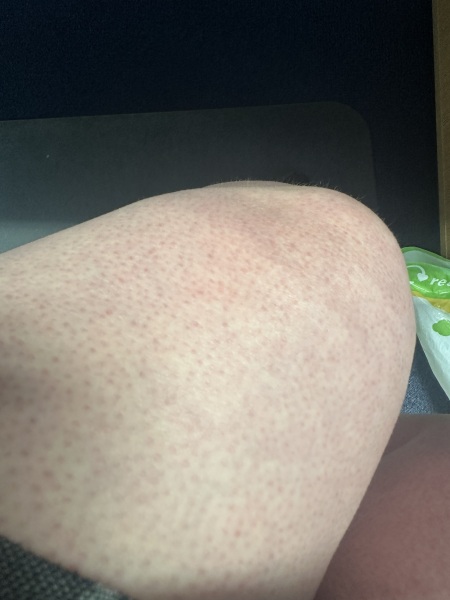 Strawberry legs and general bad skin all over - help!
