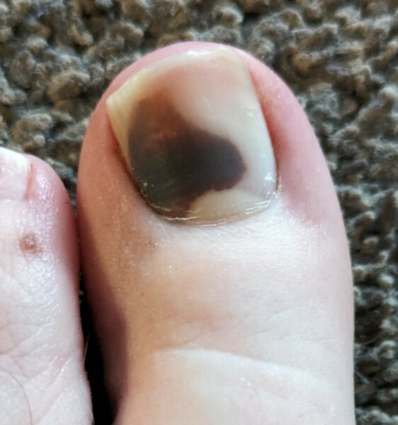 Mole under toenail
