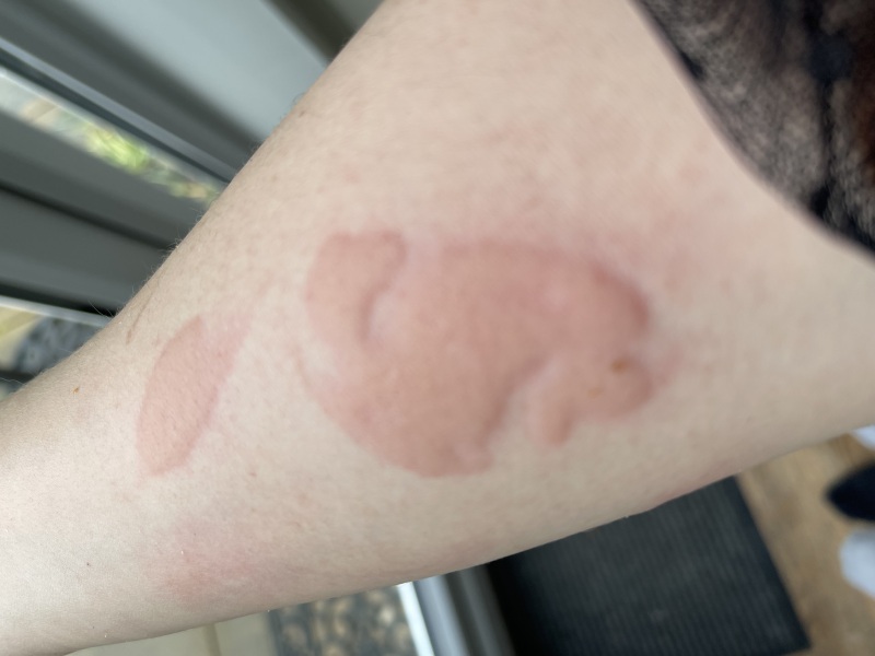 Crap! I’ve just burned myself badly with an ice pack