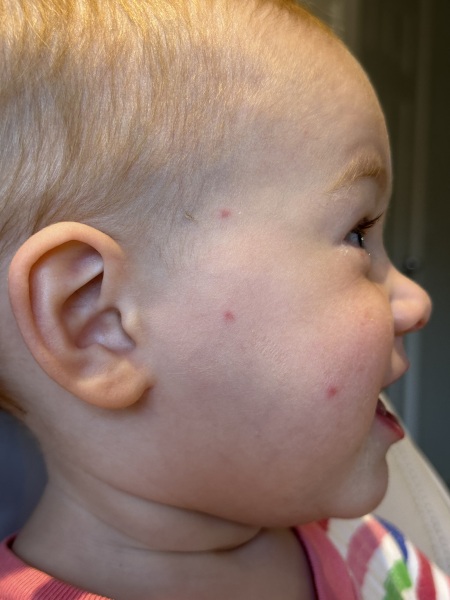 Chickenpox spots?