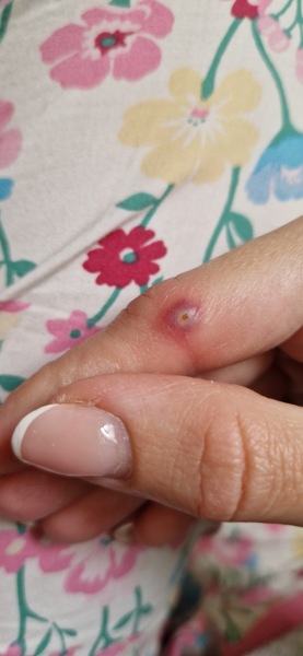 What in the name is this on my finger? (horrible photo attached)