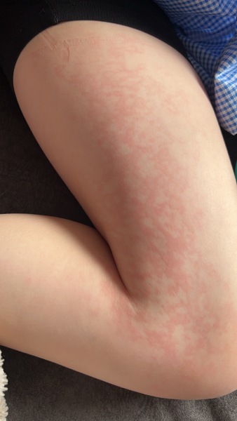 parvovirus