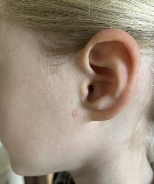 Chicken pox pock marks- the after scars! 