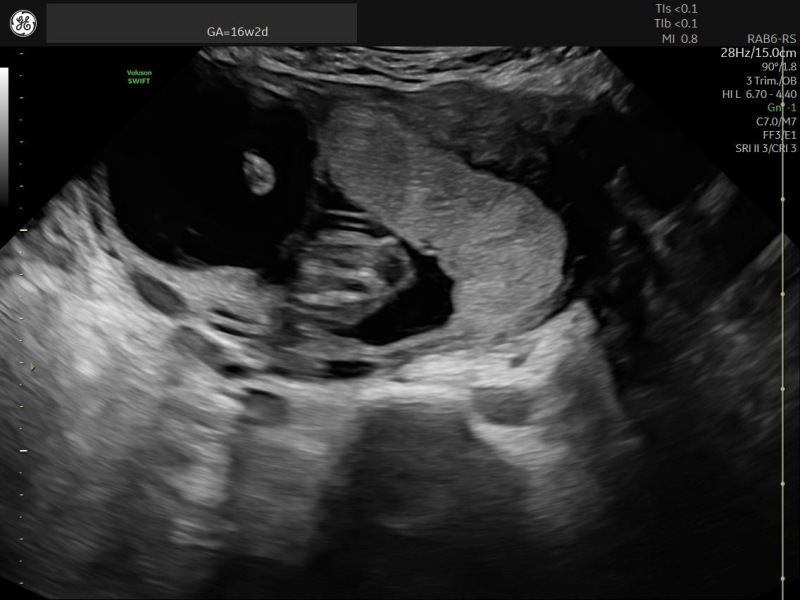 Can anyone tell which placenta variation this is?