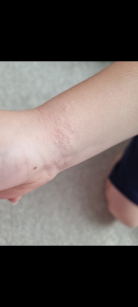 Does anyone know what this rash is