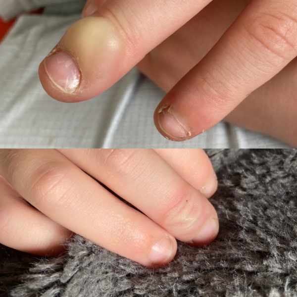 Suggestions of how to burst this