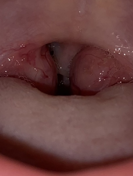 Tonsils
