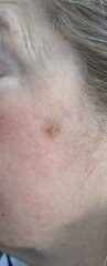 Do these moles need checked?