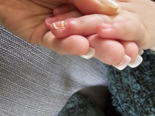 Toddlers nail falling off?