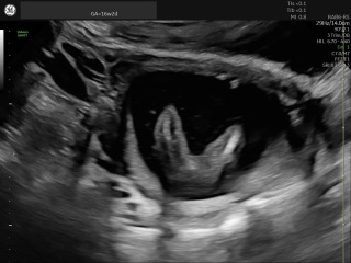 Can anyone tell which placenta variation this is?
