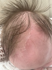 Is this cradle cap?