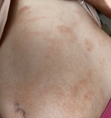What is this rash on my stomach? Photos attached