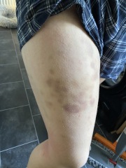 Advice on itchy skin and bruising