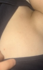 Potential Chickenpox