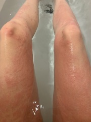 Hives all over body?