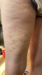 Unexplained vaginal bleeding and bruises