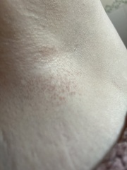 Discolour/ rash?
