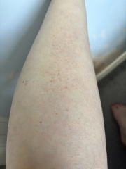 Is this heat rash?!