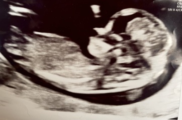 Gender guesses - 12 week scan