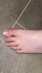 Eczema or any ideas please?