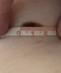 Feeling worried -Abnormal Mole Tww referral