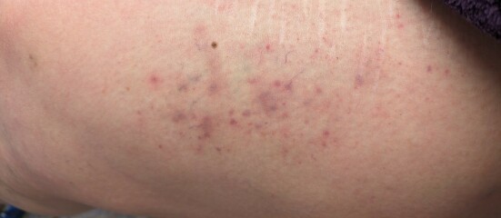 Quite a lot of bruising from itching - causes? (Photo)