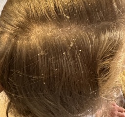 Awful dandruff 9 year old (pics)