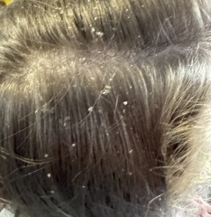 Awful dandruff 9 year old (pics)