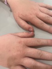 parvovirus