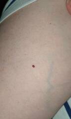 Do these moles need checked?