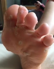 LOTS of verrucas for you