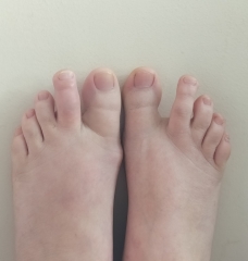 Toe still not good eight weeks after fall.