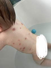 Is this even eczema?! Photo attached!