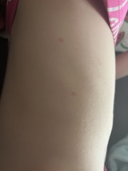 Chicken pox or something else?