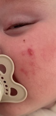 Infantile Acne / Baby Acne at 5 months