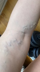 Varicose veins , do they go away ?