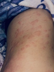To ask your advice on allergy. Photo trigger