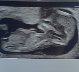 Early Glimpse said boy but I think nub looks flat? Your thoughts?