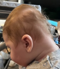 Severe plagiocephaly baby
