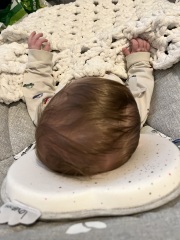 Severe plagiocephaly baby