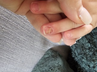 Toddlers nail falling off?