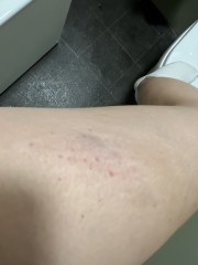 Itching and bruising