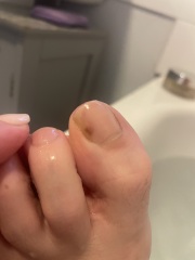 Mark on big toe
