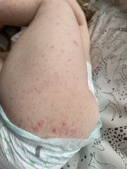 2 year old's rash/spots after eating soy