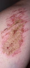 Cut infected?