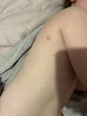 Toddlers skin spots