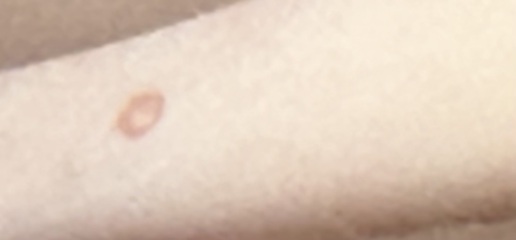 Chicken pox or molloscum?