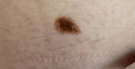 Feeling worried -Abnormal Mole Tww referral