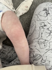 Badly mottled skin 1 year old